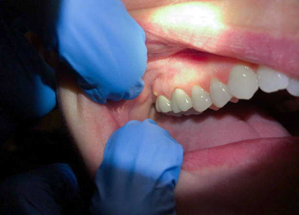 Best Dentist for Tooth Abscess  in James City, NC
